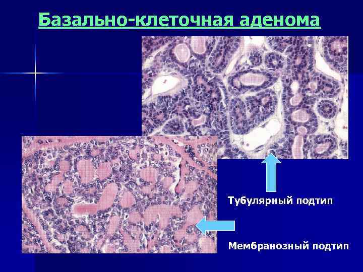Базально-клеточная аденома     Тубулярный подтип     Мембранозный подтип