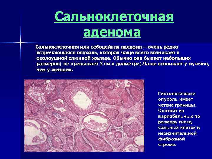  Сальноклеточная  аденома Сальноклеточная или себоцейная аденома – очень редко встречающаяся опухоль, которая