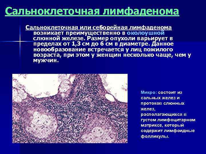 Сальноклеточная лимфаденома  Сальноклеточная или себорейная лимфаденома возникает преимущественно в околоушной слюнной железе. Размер