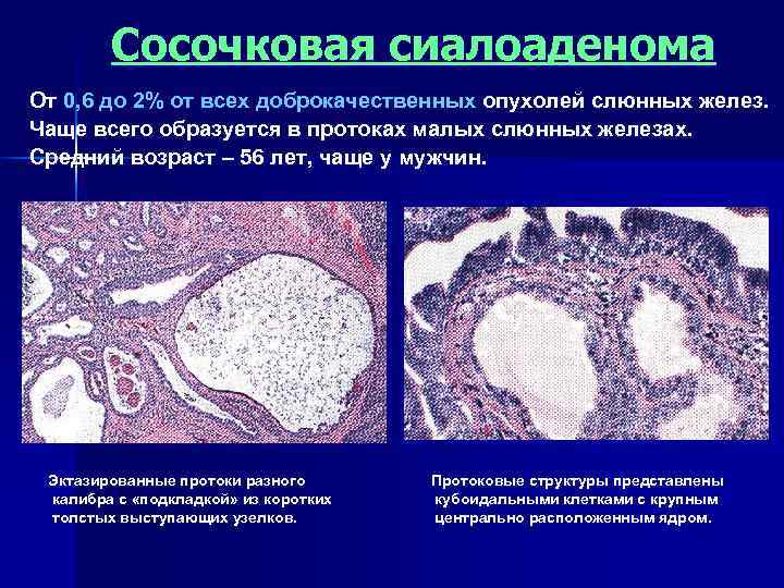   Сосочковая сиалоаденома От 0, 6 до 2% от всех доброкачественных опухолей слюнных