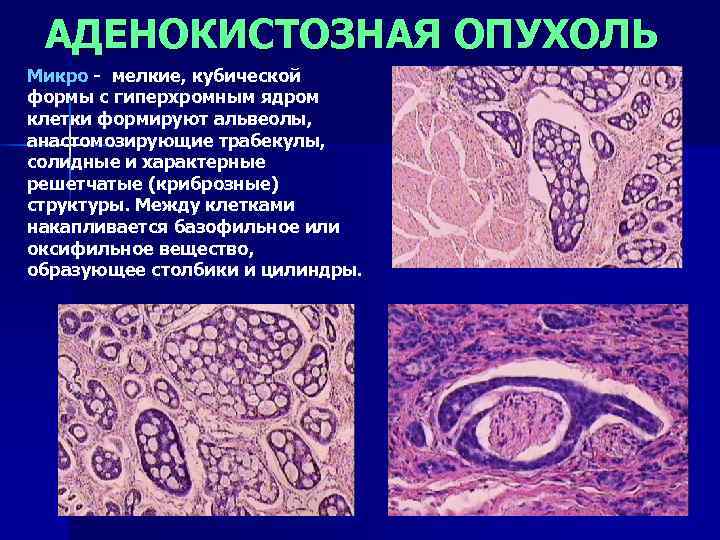  АДЕНОКИСТОЗНАЯ ОПУХОЛЬ Микро - мелкие, кубической формы с гиперхромным ядром клетки формируют альвеолы,