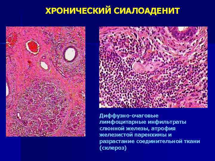 Реактивно дистрофические заболевания слюнных желез презентация