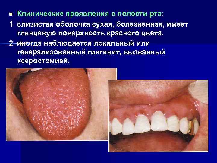 n Клинические проявления в полости рта: 1. слизистая оболочка сухая, болезненная, имеет  глянцевую
