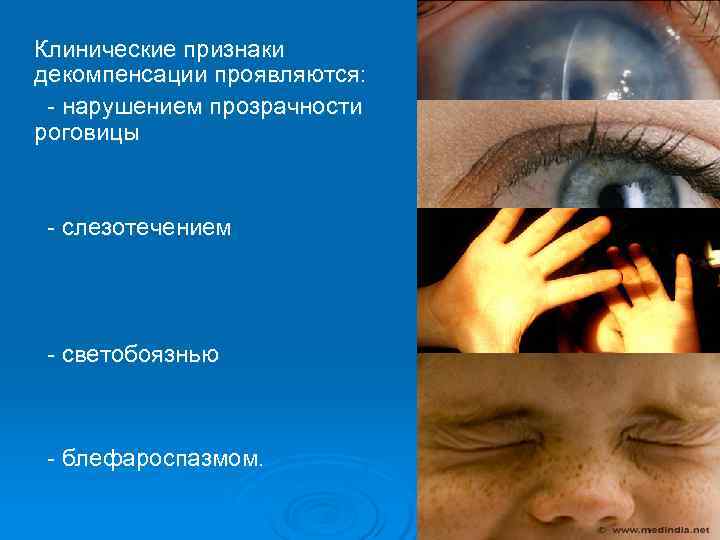   Клинические признаки декомпенсации проявляются:  - нарушением прозрачности роговицы   -