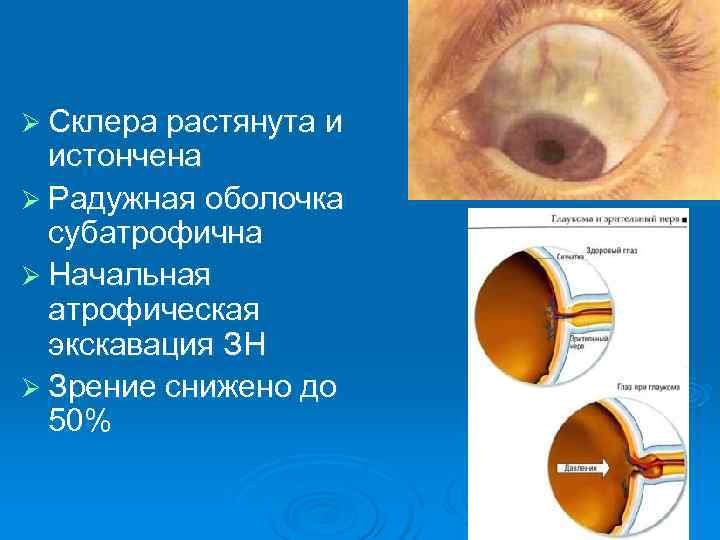Ø Склера растянута и  истончена Ø Радужная оболочка  субатрофична Ø Начальная 