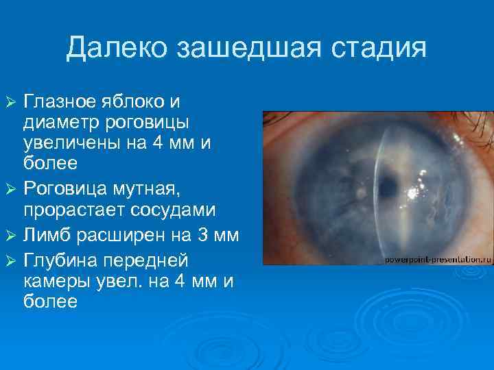  Далеко зашедшая стадия Ø Глазное яблоко и  диаметр роговицы  увеличены на
