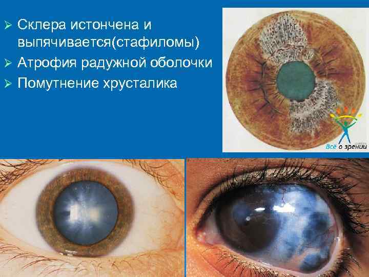 Ø Склера истончена и  выпячивается(стафиломы) Ø Атрофия радужной оболочки Ø Помутнение хрусталика 