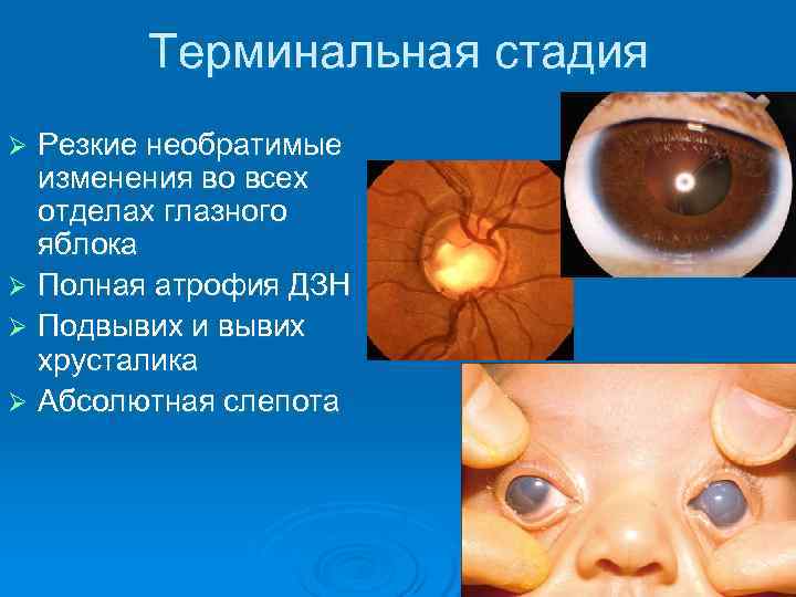   Терминальная стадия Ø Резкие необратимые  изменения во всех  отделах глазного