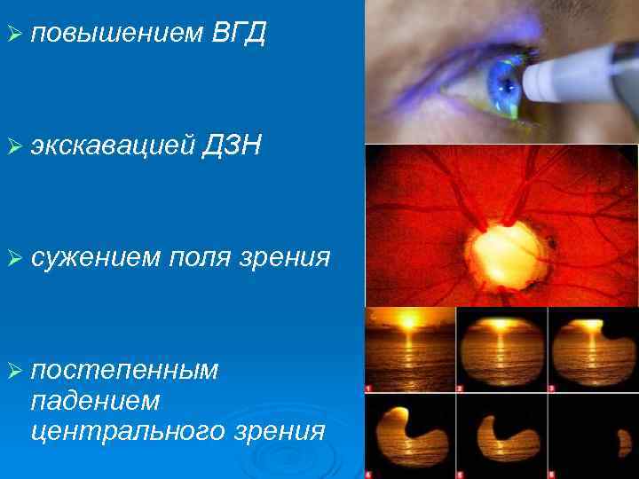 Ø повышением ВГД  Ø экскавацией ДЗН  Ø сужением поля зрения  Ø