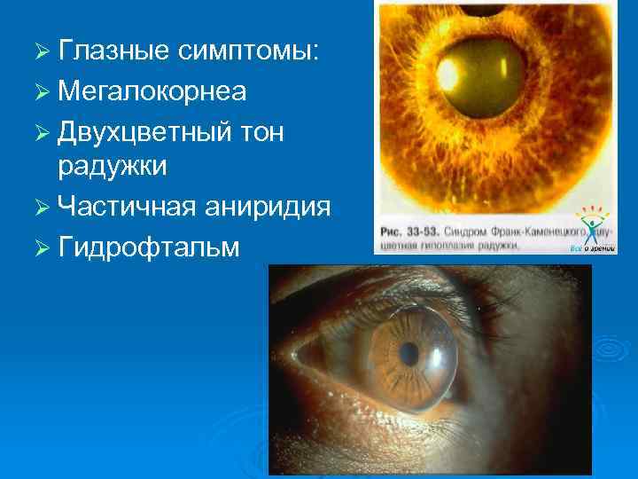 Ø Глазные симптомы: Ø Мегалокорнеа Ø Двухцветный тон  радужки Ø Частичная аниридия Ø
