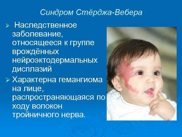    Синдром Стёрджа-Вебера Ø  Наследственное  заболевание, относящееся к группе 