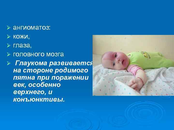Ø ангиоматоз: Ø кожи,  Ø глаза,  Ø головного мозга Ø Глаукома развивается