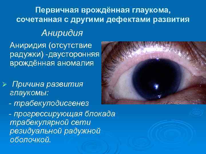    Первичная врождённая глаукома,  сочетанная с другими дефектами развития  Аниридия