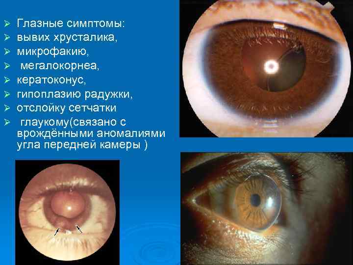 Ø  Глазные симптомы:  Ø  вывих хрусталика,  Ø  микрофакию, Ø