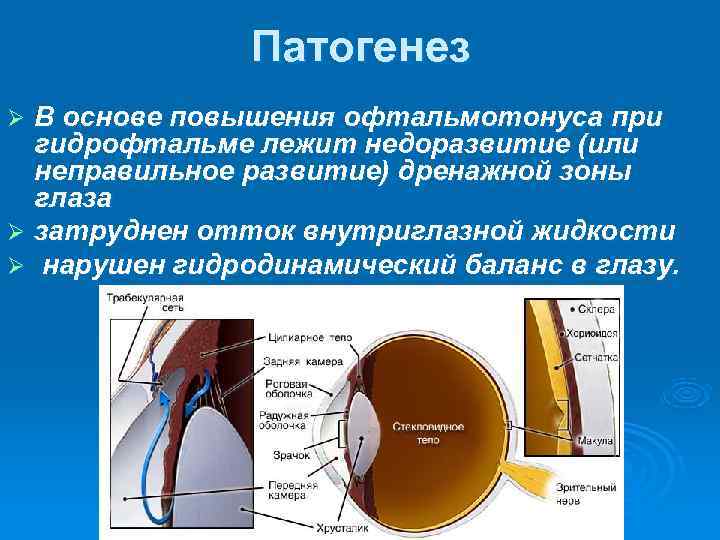     Патогенез Ø В основе повышения офтальмотонуса при  гидрофтальме лежит