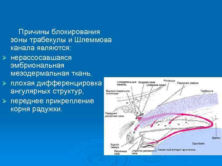   Причины блокирования зоны трабекулы и Шлеммова канала являются:  Ø нерассосавшаяся эмбриональная