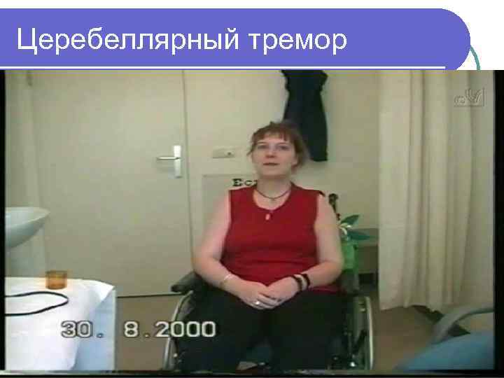Церебеллярный тремор 
