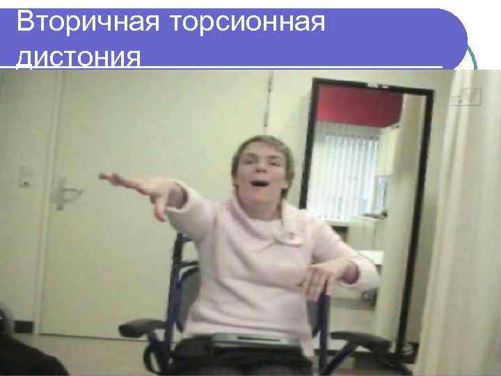 Вторичная торсионная дистония 