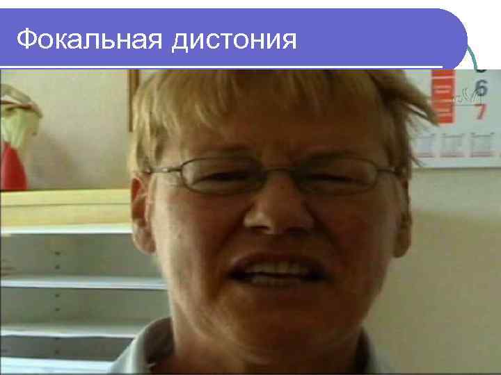 Фокальная дистония 