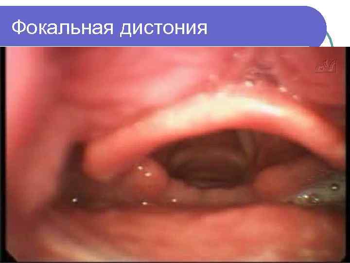 Фокальная дистония 