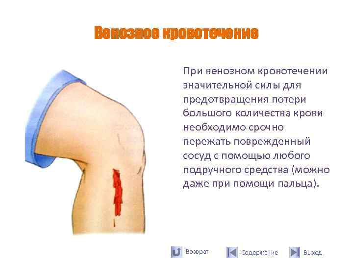Венозное кровотечение   При венозном кровотечении  значительной силы для  предотвращения потери