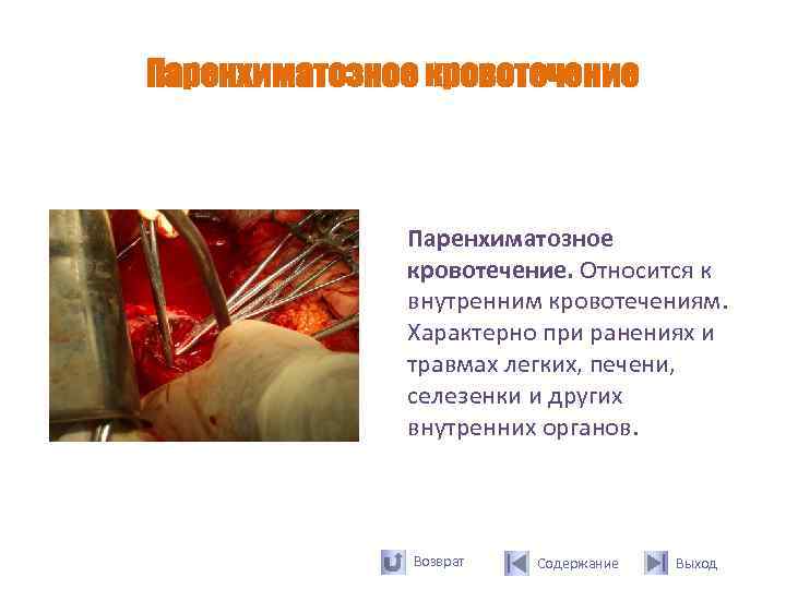 Паренхиматозное кровотечение   Паренхиматозное    кровотечение. Относится к   