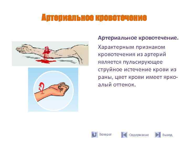 Артериальное кровотечение    Артериальное кровотечение.    Характерным признаком  