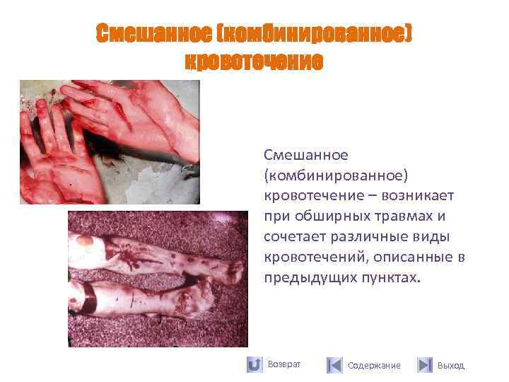Смешанное (комбинированное)  кровотечение   Смешанное    (комбинированное)   