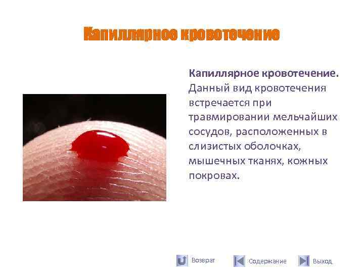 Капиллярное кровотечение   Капиллярное кровотечение.   Данный вид кровотечения   встречается