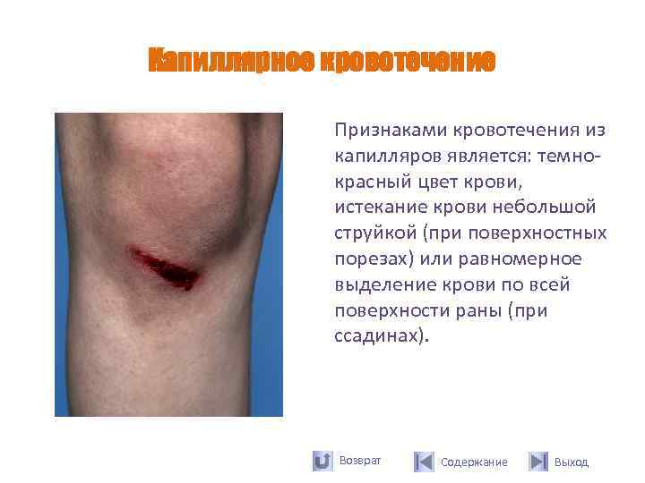Капиллярное кровотечение   Признаками кровотечения из   капилляров является: темно-  
