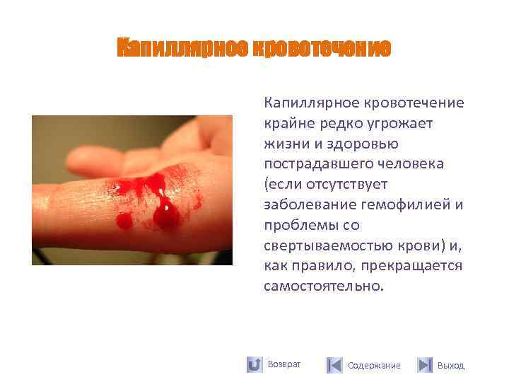 Капиллярное кровотечение   крайне редко угрожает   жизни и здоровью  