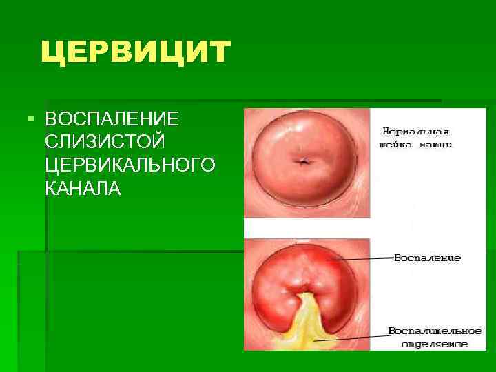  ЦЕРВИЦИТ § ВОСПАЛЕНИЕ  СЛИЗИСТОЙ  ЦЕРВИКАЛЬНОГО  КАНАЛА 