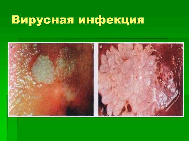 Вирусная инфекция 