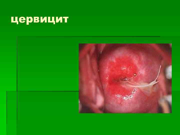 цервицит 