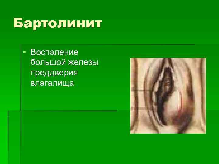 Бартолинит  § Воспаление  большой железы  преддверия  влагалища 
