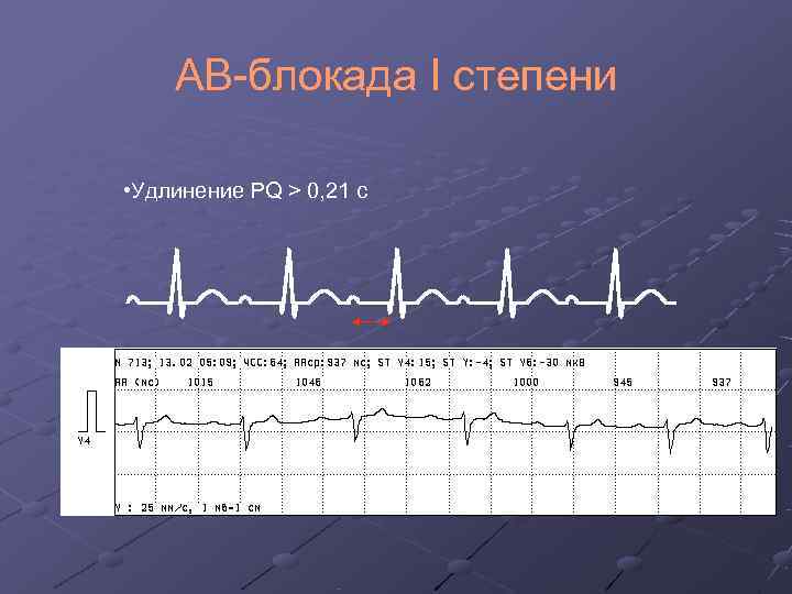   АВ-блокада I степени  • Удлинение PQ > 0, 21 с 