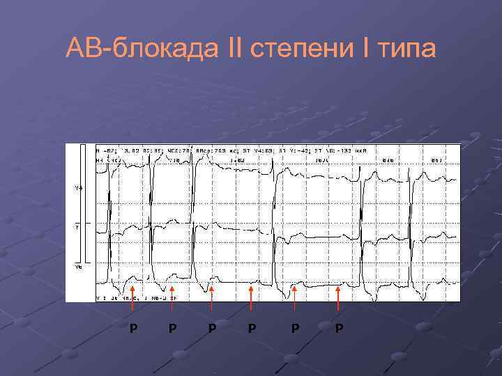 АВ-блокада II степени I типа   Р  Р  Р 