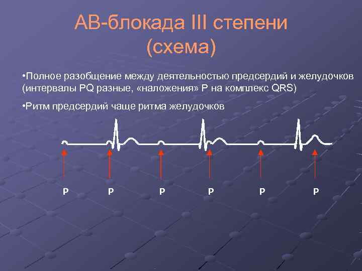   АВ-блокада III степени   (схема) • Полное разобщение между деятельностью предсердий