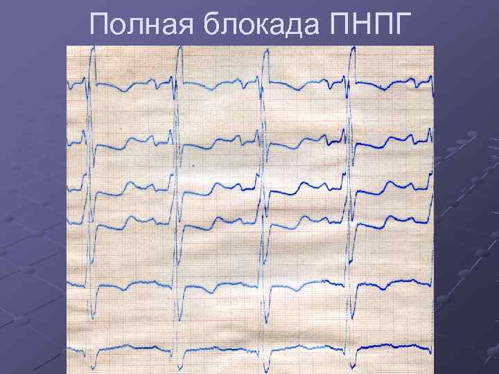 Полная блокада ПНПГ 