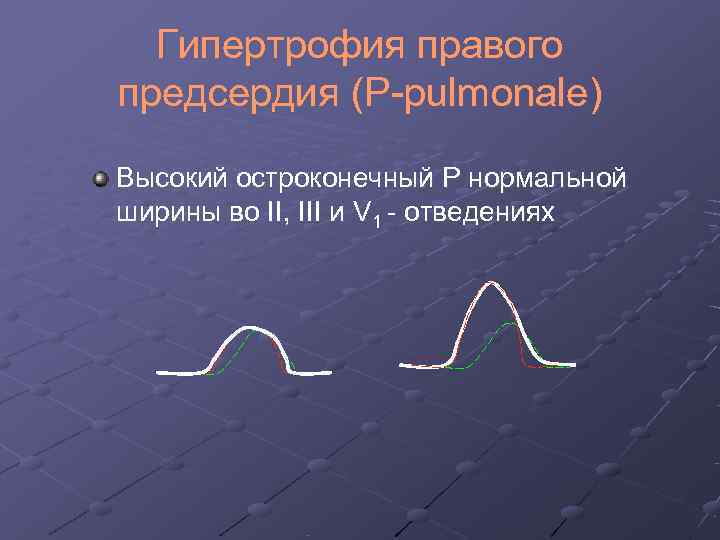  Гипертрофия правого предсердия (P-pulmonale) Высокий остроконечный Р нормальной ширины во II, III и