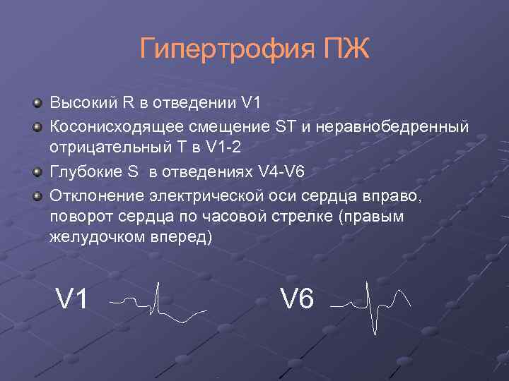    Гипертрофия ПЖ Высокий R в отведении V 1 Косонисходящее смещение ST