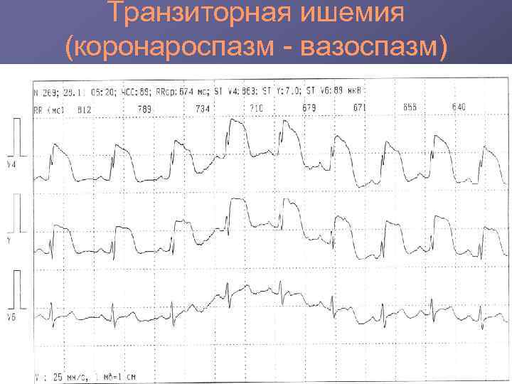   Транзиторная ишемия (коронароспазм - вазоспазм) 