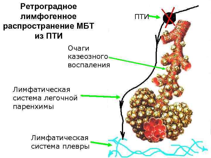   Ретроградное лимфогенное   ПТИ распространение МБТ  из ПТИ  