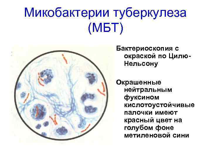 Палочки в мокроте. Микроскопия мокроты на туберкулез. Бактериоскопия мокроты по Цилю Нильсену. Микроскопия мокроты на МБТ. Микроскопия мокроты при туберкулезе.