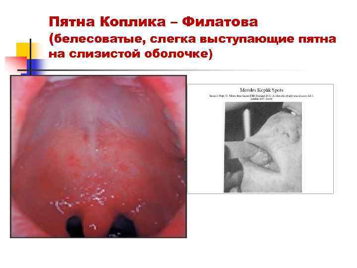 Пятна Коплика – Филатова (белесоватые, слегка выступающие пятна на слизистой оболочке) 