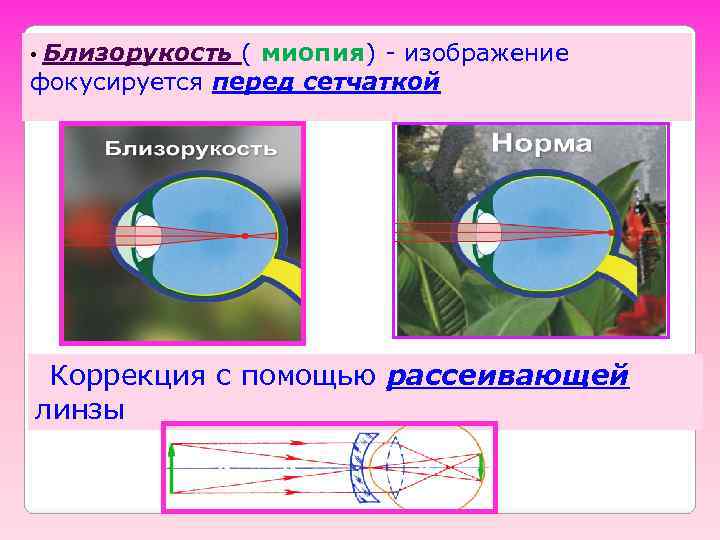  • Близорукость ( миопия) - изображение фокусируется перед сетчаткой Коррекция с помощью рассеивающей