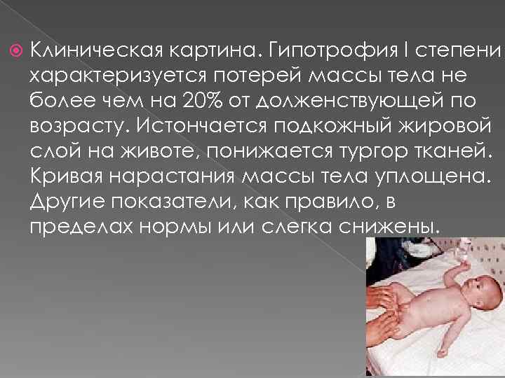   Клиническая картина. Гипотрофия I степени характеризуется потерей массы тела не более чем
