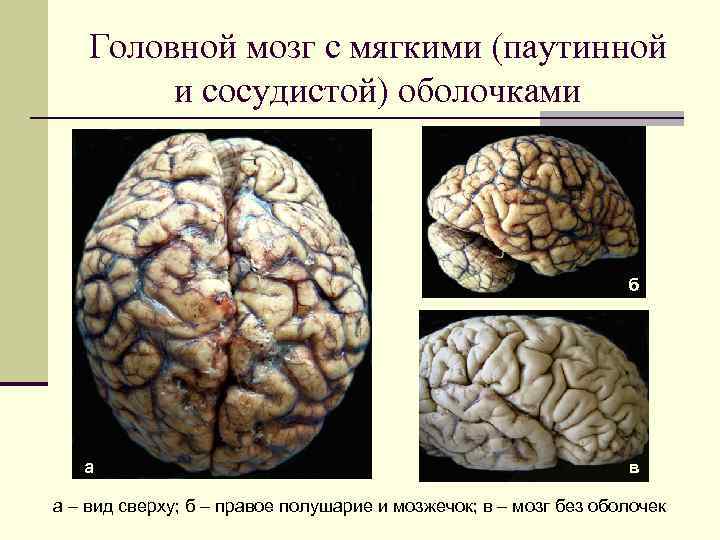 Сосудистая оболочка мозга. Паутинная оболочка головного мозга. Мягкая оболочка головного мозга. Мягкая сосудистая оболочка головного мозга.