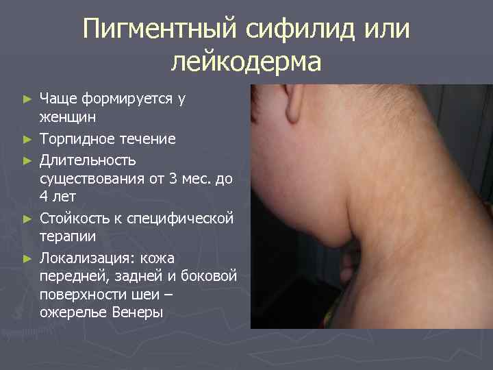    Пигментный сифилид или    лейкодерма ►  Чаще формируется