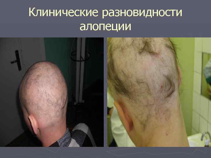Клинические разновидности   алопеции 